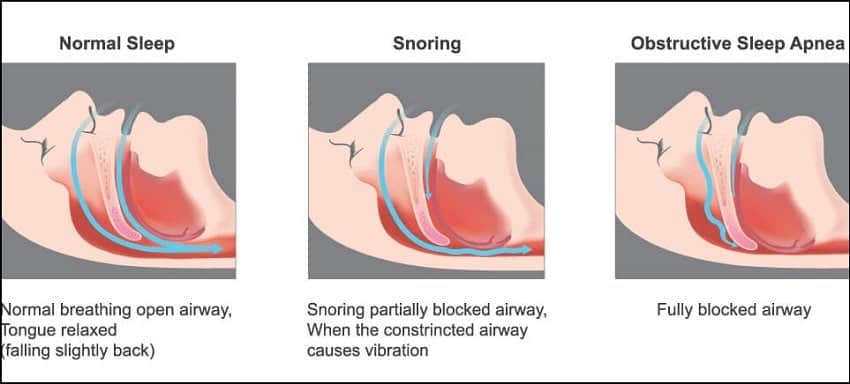 Snoring in Children